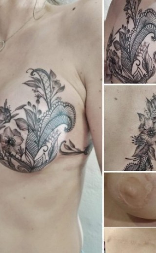 Le tatouage correcteur de cicatrices