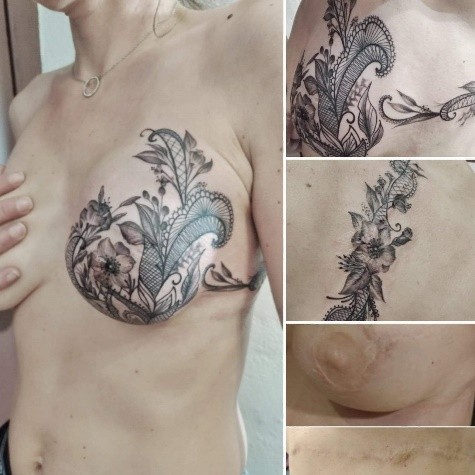 Le tatouage correcteur de cicatrices