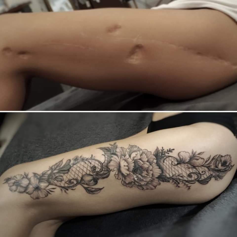 Tatouage correcteur de cicatrices